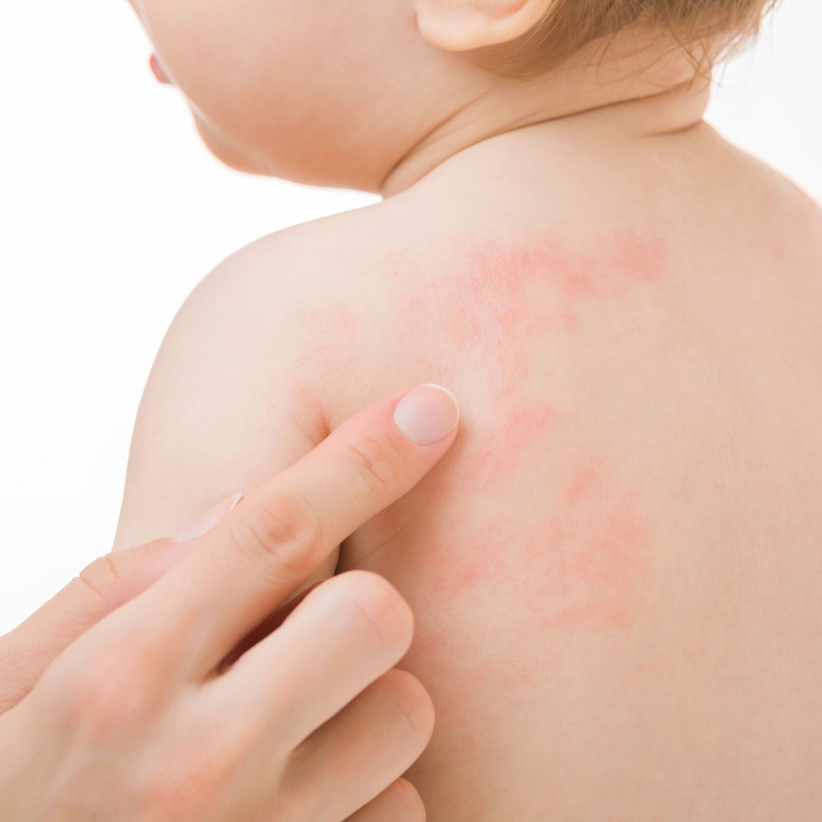 How to bathe a baby with dermatitis